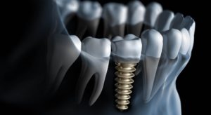 Implant dentar - Laborator Tehnica Dentara Stomalux